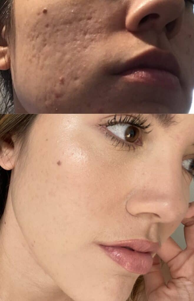 microneedling pen before and after