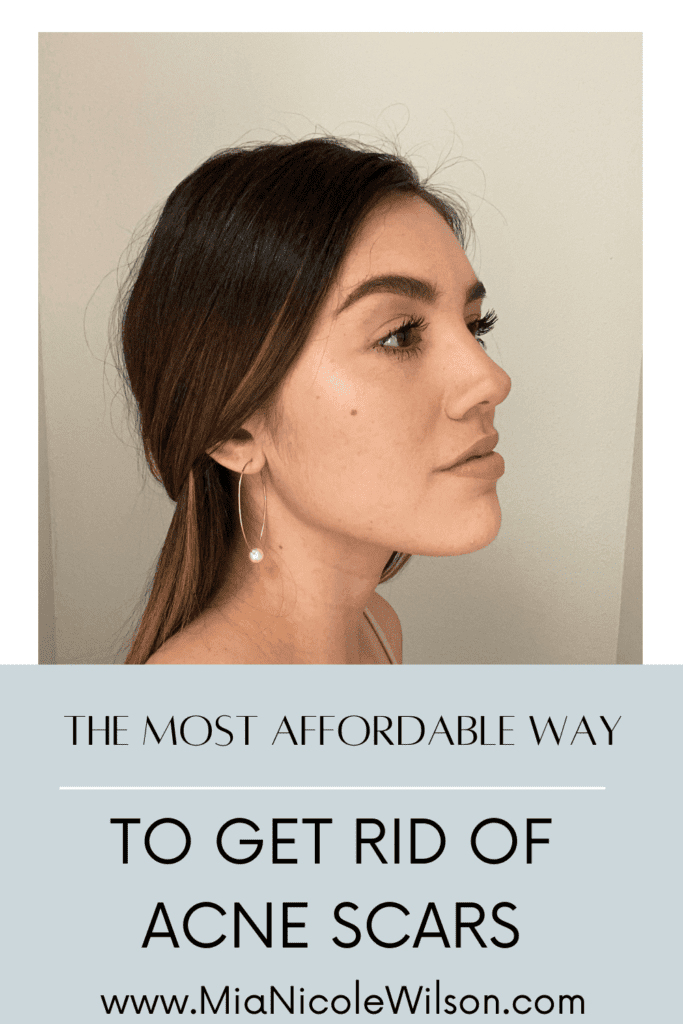 microneedling for acne scars