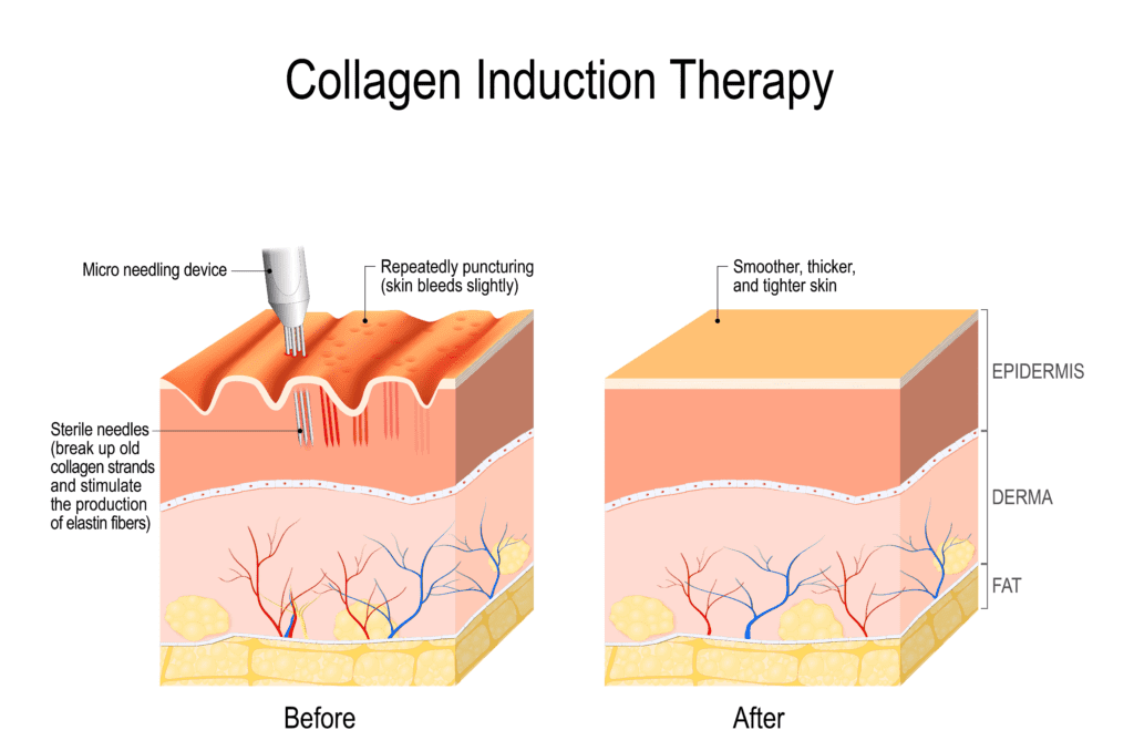 An illustration depicting how microneedling stimulates the production of elastin fibers. Collagen induction therapy is another name for this.