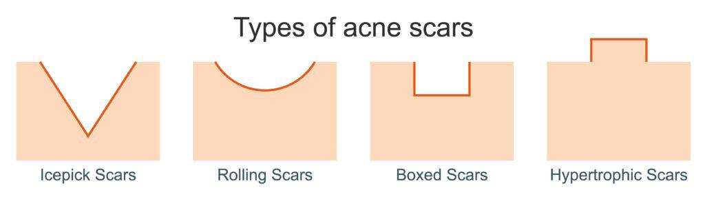 A diagram describing the different types of acne scars. There are three types of atrophic acne scars, as well as hypertrophic acne scars. 