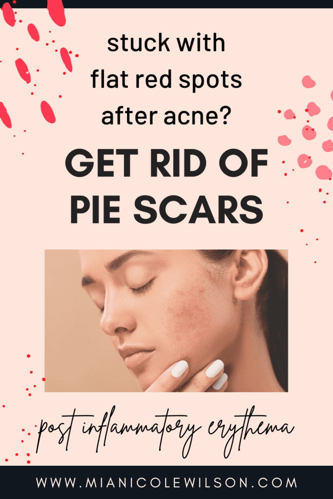 How to get rid of pie scars post inflammatory erythema easily and affordably. 