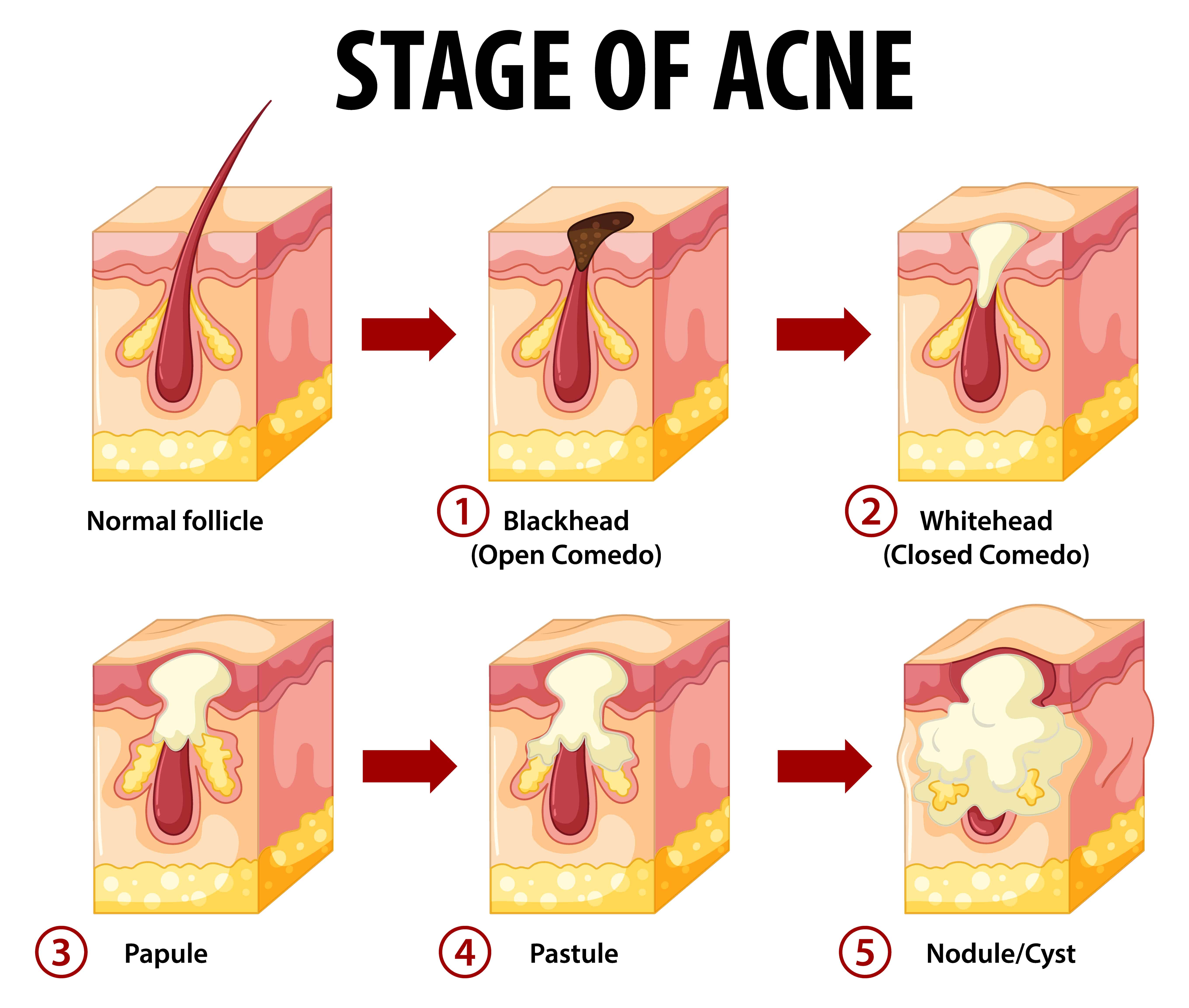 Diagram of the Stages of acne and pimples