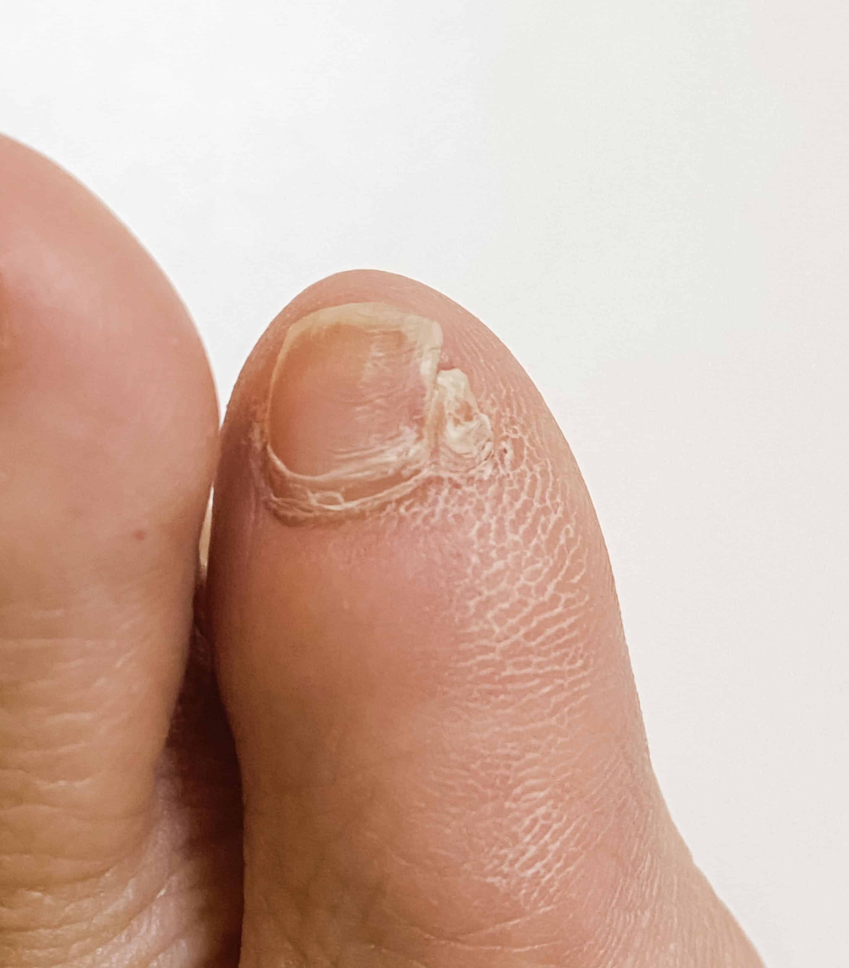 are-your-double-pinky-toenails-bothering-you-here-s-how-to-fix