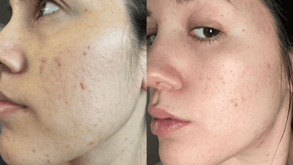 chemical peels before and after results for acne scars