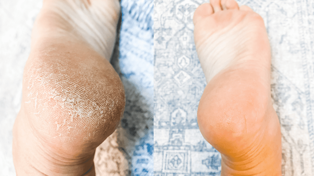 using glycolic acid for feet