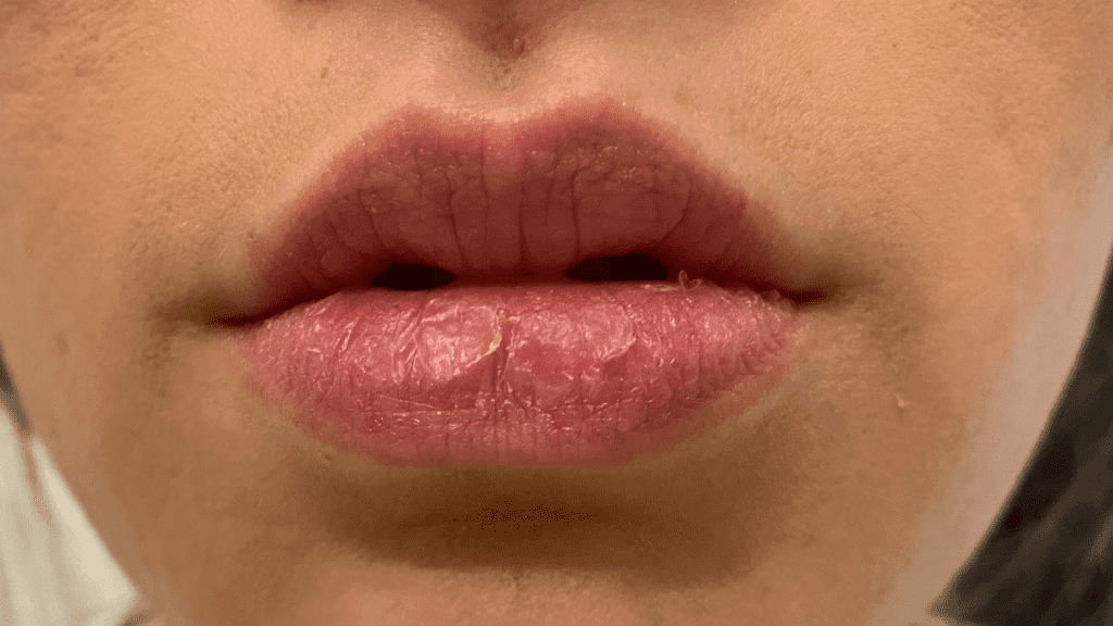 dry lips from accutane