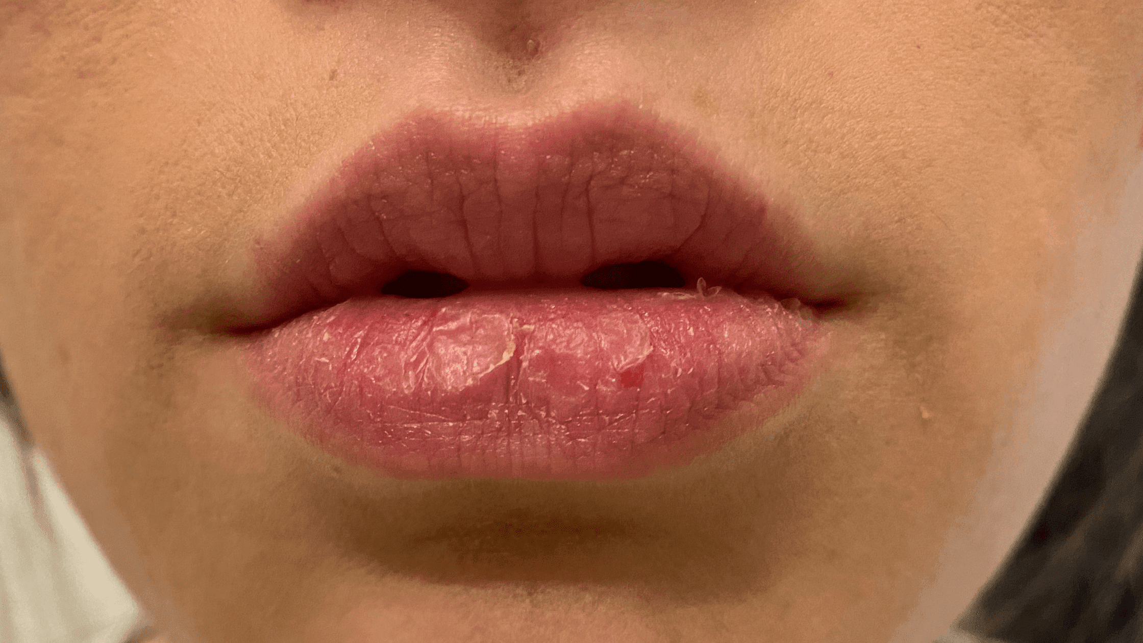 I Still Have Dry Lips From Accutane ... 13 Years Later - Hello Mia Wilson