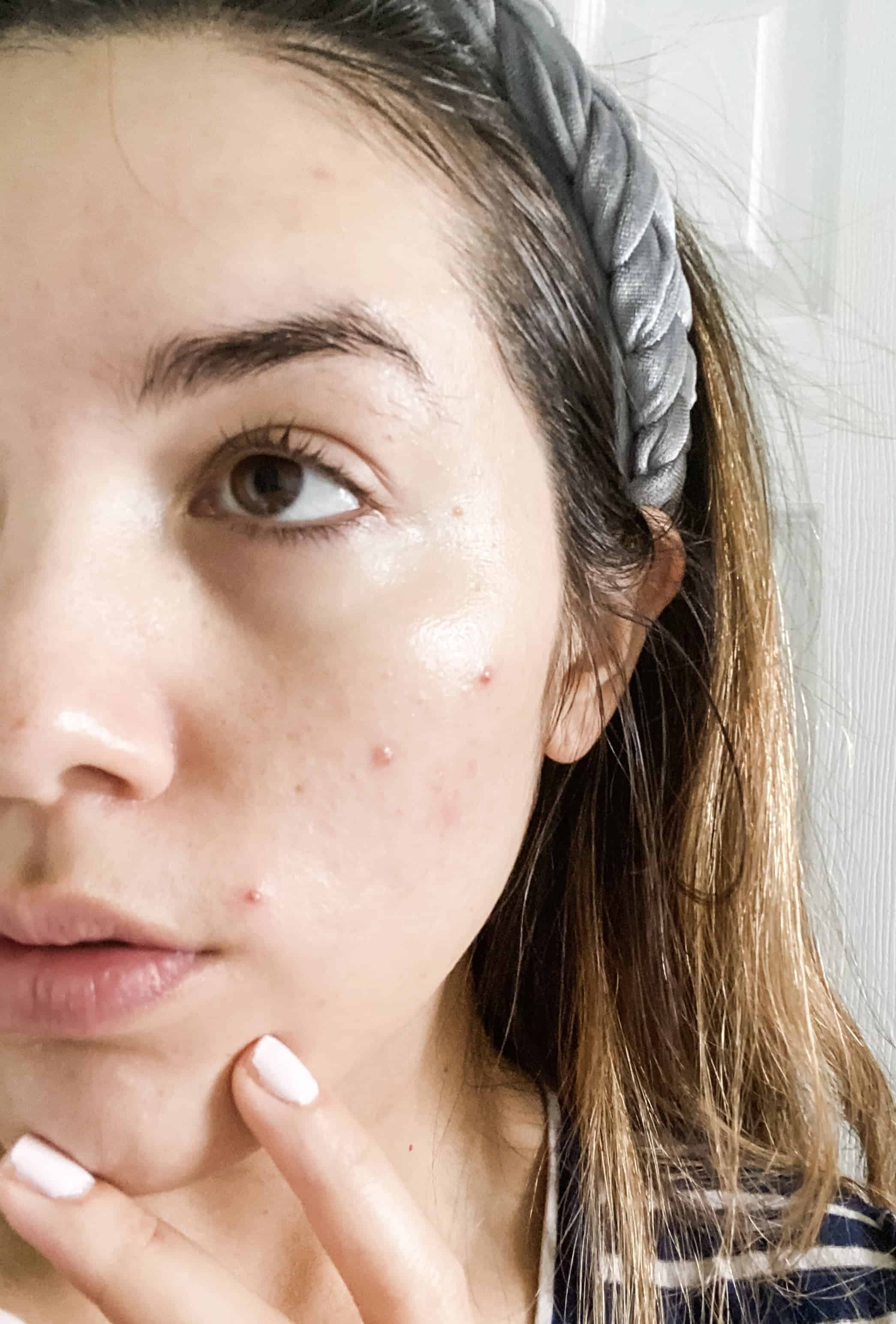 Pimple Keeps Coming Back After Popping? Here’s 4 Easy Fixes