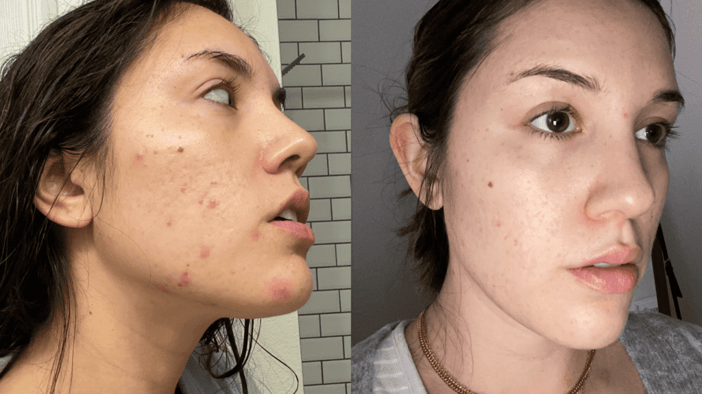 Mad hippie vitamin c serum results before and after