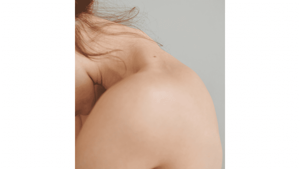 how to get rid of back acne scars