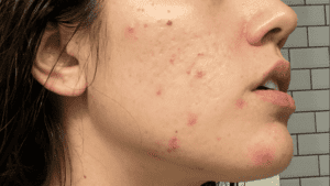 how to get rid of pregnancy acne naturally