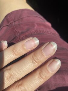 fingernails with ridges