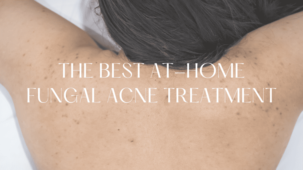 FUNGAL ACNE TREATMENT AT HOME