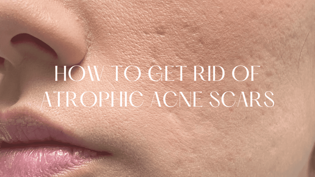 HOW TO GET RID OF ATROPHIC ACNE SCARS