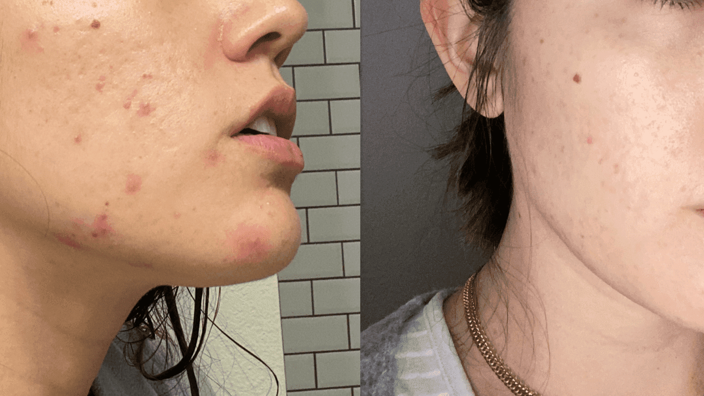 pregnancy acne before and after